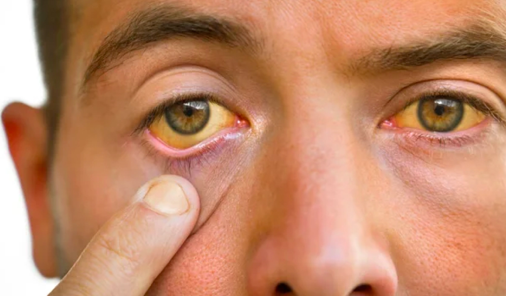 ictericia-sintomas-diagnostico-cuidado ictericia-sintomas-diagnostico-cuidado
