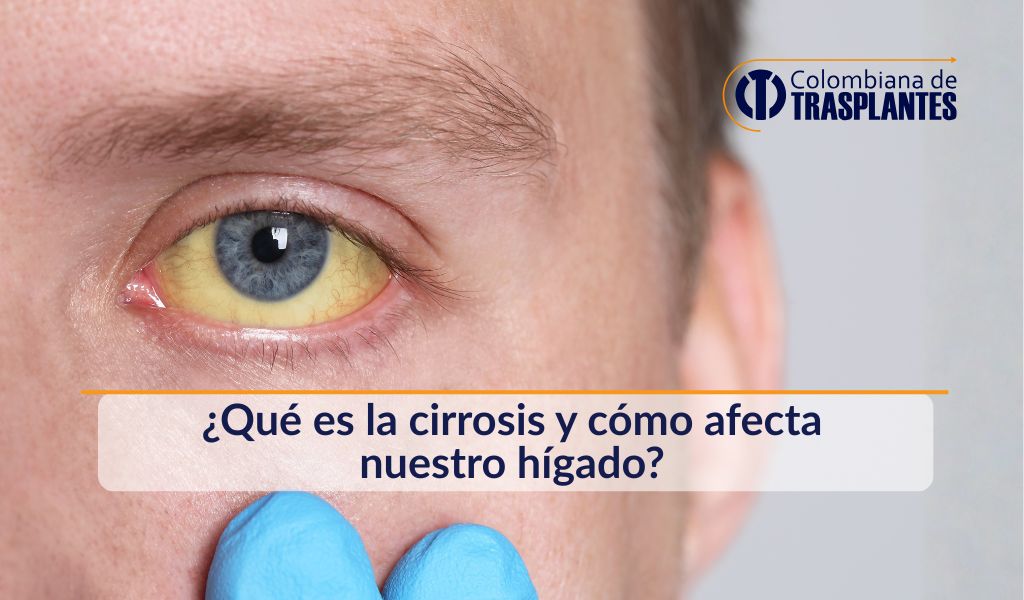 cirrosis-que-es-como-afecta-higado-sintomas-tratamiento